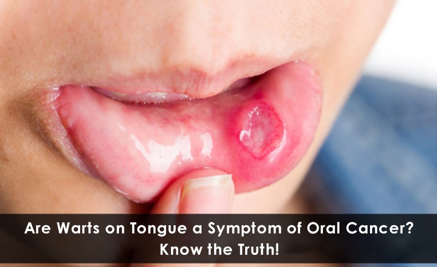 Are Warts on Tongue a Symptom of Oral cancer