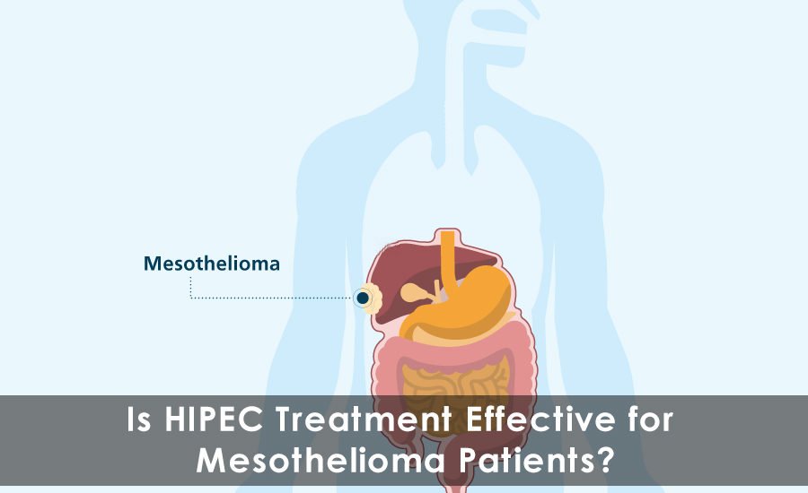 Is HIPEC Treatment Effective for Mesothelioma Patients