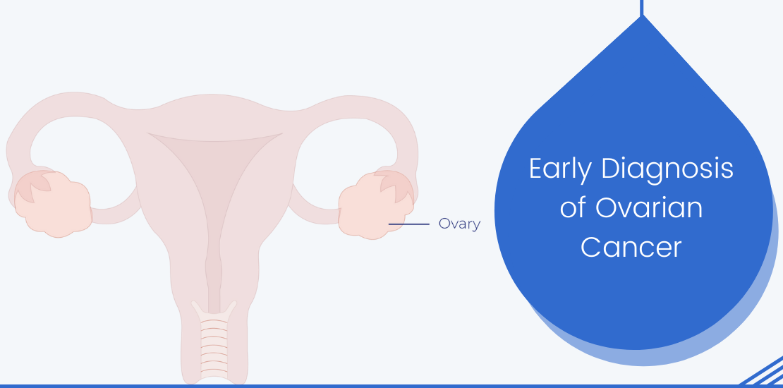 Early Diagnosis of Ovarian Cancer